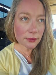 Eucerin lotion effective for psoriasis plaques