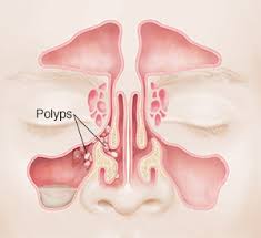Broadly defined, nasal polyps are abnormal lesions that originate from any portion of the nasal mucosa or paranasal sinuses. Understanding Nasal Polyps