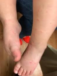 The Dreaded Virus Hand Foot And Mouth Disease Spring Valley Pediatrics