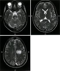 Its high sensitivity for the evaluation of inflammatory and neurodegenerative processes in the brain and spinal cord has made it the most commonly used technique for the evaluation of patients with ms. Multiple Sclerosis Knowledge Amboss