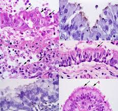 Kohno n, kyoizumi s, awaya y, fukuhara h, yamakido m, akiyama m. Bordetella Bronchiseptica Pneumonia In Dogs A B D F And A Cat C Download Scientific Diagram
