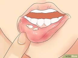 Both types of hsv can infect both the mouth and the genitals. How To Recognize Herpes 10 Steps With Pictures Wikihow