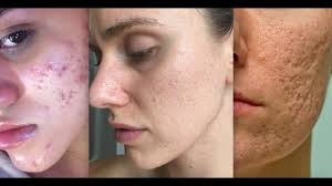 types of acne s you