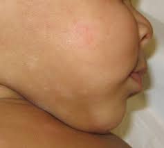 Cara menghilangkan panu sampai ke akarnya yang paling penting adalah menjaga kebersihan wajah dan tubuh. Macam Panau Tapi Bukan Ini 5 Perkara Tentang Tompokan Putih Pada Muka Anak