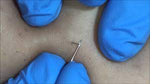 There are currently 10 electrolysis + ingrown hair questions and doctor answers on realself. How To Remove Ingrown Hairs Pre Electrolysis Care Youtube