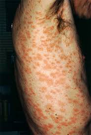 Drink lots of water to thin secretions and ease expectoration. Pityriasis Rosea Stages Treatment Rash Symptoms Pregnancy