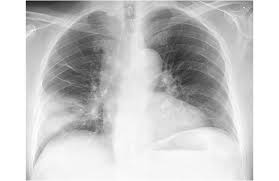 It can be mild or very serious. Ai Powered Radiology Model Diagnoses Pneumonia In 10 Seconds Medical Design And Outsourcing
