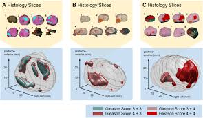 Check spelling or type a new query. Accurate Validation Of Ultrasound Imaging Of Prostate Cancer A Review Of Challenges In Registration Of Imaging And Histopathology Springerlink