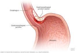 Stomach cancers are more likely to develop in those who have previously had part of their stomach removed in surgery. Stomach Cancer Symptoms And Causes Mayo Clinic