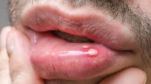 Is mouth herpes contagious, symptoms of mouth herpes, signs, early signs, pictures,photos, treatment, remedies, cures. Is It Herpes Or Something Else Everyday Health
