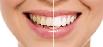 We did not find results for: Teeth Whitening Treatments And Professional Dental Whitening Pembroke Dental Clinics