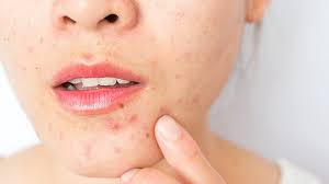 How to get rid of stress looking face. Adult Acne 10 Surprising Causes And How To Get Rid Of It Everyday Health