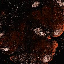 Image result for Subclinical Hyperthyroidism