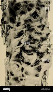 spleen with numerous filarial embryos ...