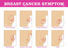 Extreme swelling that can pop up almost overnight with inflammatory breast cancer. Breast Cancer Symptoms Infographic Royalty Free Cliparts Vectors And Stock Illustration Image 87714044