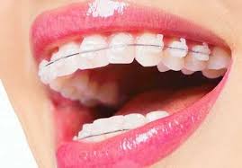 брикеты на зубах