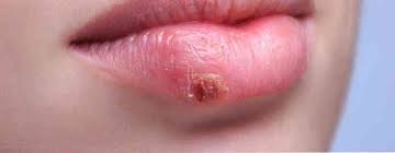Apabila sudut bibir kering, kulit akan mudah retak dan cedera. 6 Tabiat Untuk Bibir Kering Dan Terputus Maklumat Kesihatan Petua Perubatan Dan Maklumat Kesihatan Yang Berguna