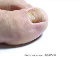 Image result for Beau lines feet