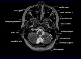 Axial Mri Labeled Google Search Brain Anatomy Radiology Imaging Mri