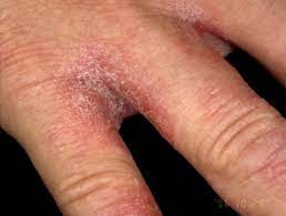 Irritant contact dermatitis | DermNet