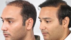 Mohammed Azharuddin's son Asaduddin gets hair transplant, before and after  transformation pics go viral