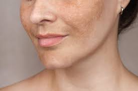 Image result for Melasma