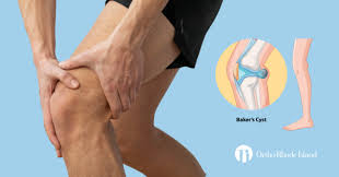 Image result for Knee Bulge Sign