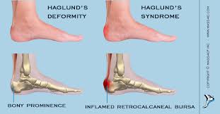 The condition often needs treatment if it causes pain. How To Treat Haglund S Syndrome Mass4d Foot Orthotics
