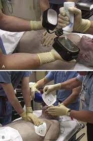 Defibrillation is achieved by delivering a strong electric current though electrodes placed on the surface of a patient's chest wall. Defibrillation And Cardioversion Clinical Gate