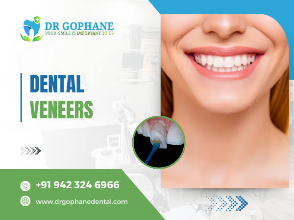 Dental Veneers In Yavatmal product image