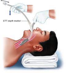 Looking for the definition of lma? Laryngeal Mask Airway Springerlink
