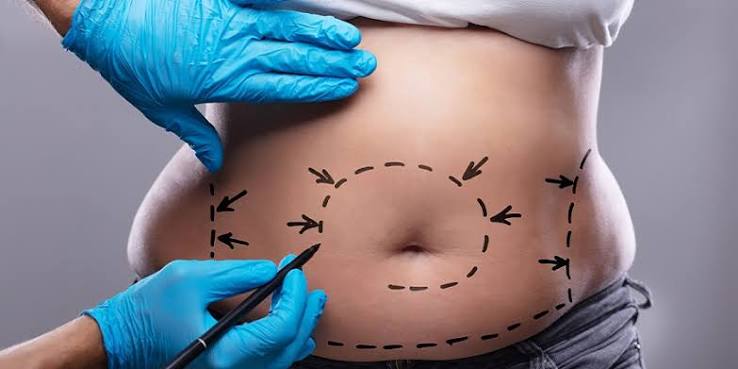 Lipo Abdominoplasty In Riyadh & Saudi Arabia | Cost & Price