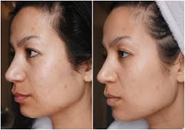 Snelle oplossing voor pigmentvlekken ⋆ Beautylab.nl