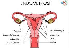 L'endometriosi può svilupparsi in varie sedi L Endometriosi E L Osteopatia Physiolife Velletri