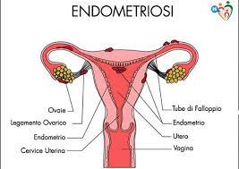 L'endometriosi è la presenza di endometrio e stroma di endometrio al di fuori della cavità uterina in altre zone del corpo femminile, normalmente nella pelvi. L Endometriosi E L Osteopatia Physiolife Velletri