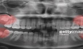 Bleeding and tender gum tissue: What To Expect If You Need To Get Your Wisdom Teeth Removed Rifkin Dental Dentists