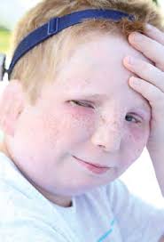 thankful for crouzon syndrome