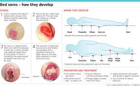 Bedroom furniture sets without bedsores medicines. Hospitals Ramp Up Battle Against Bed Sores Health News Top Stories The Straits Times