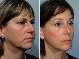 Here's a great solution recommend by beauty experts for firmer, younger looking skin. The 6 Types Of Facelifts Pearlman Aesthetic Surgery