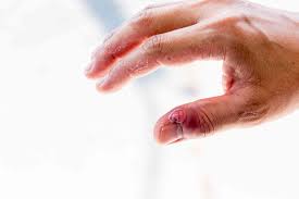 These beauty procedures can damage the cuticle and fresh nail growth at the base. Skin Infection Around Fingernails And Toenails