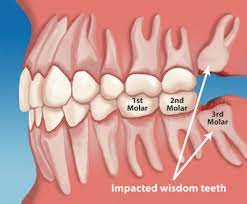 How are wisdom teeth stuck in your jaw? Do I Need To Remove My Wisdom Teeth Kingstowne Family Cosmetic Dentistry