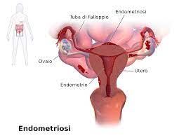 An endometrioma which is filled with old blood is called a chocolate cyst. Endometriosi Wikipedia