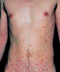 Complications of pityriasis rosea aren't likely. Pityriasis Rosea Fully Evolved Two Weeks After Onset Reprinted With Download Scientific Diagram
