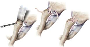 Image result for SC Dislocation