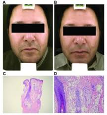 SILIKON 1000 AND GRANULOMAS (BIOPOLYMEROS AND ARTIFICIAL SILICONE SHOTS)