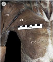 Deep breast pain and shooting pains in the breast are often difficult to understand and treat. Anatomical Variations Of The Pectoralis Major Muscle Notes On Their Impact On Pectoral Nerve Innervation Patterns And Discussion On Their Clinical Relevance