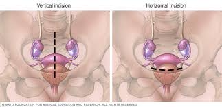 Because the surgeon usually leaves part or all of the ovaries intact, it may still be possible to develop ovarian cancer. Abdominal Hysterectomy Mayo Clinic
