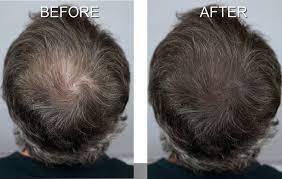 Gallery Hair Loss Solution Scalp Shading Hairstyles For Thin Hair Hair Loss Remedies Help Hair Loss