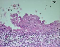 Reactive mesothelial cells are seen in a variety of systemic diseases (les, . Reactive Mesothelial Hyperplasia Mimicking Mesothelioma In An African Green Monkey Chlorocebus Aethiops Abstract Europe Pmc