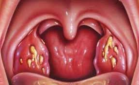 Dokumen, saya ingin meminta lebih banyak bintik putih pada pipi pada bayi saya, jika saya membersihkan bayi saya menangis, kemudian cuba memancarkannya. Bintik Putih Di Tekak Sebab Sebab